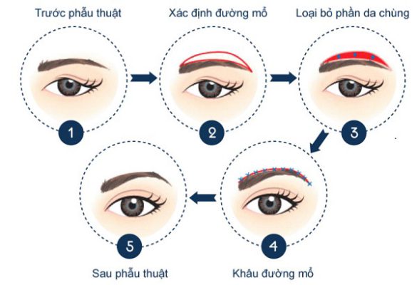 Sau khi phẫu thuật nâng cung mày, việc chăm sóc đúng cách là rất quan trọng để đảm bảo kết quả thẩm mỹ như mong muốn và phòng ngừa các biến chứng