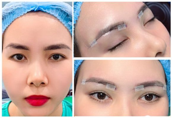 Tuyệt Diệu là địa chỉ uy tín hàng đầu trong lĩnh vực thẩm mỹ, nơi hội tụ đội ngũ bác sĩ với hơn 15 năm kinh nghiệm về nâng cung mày