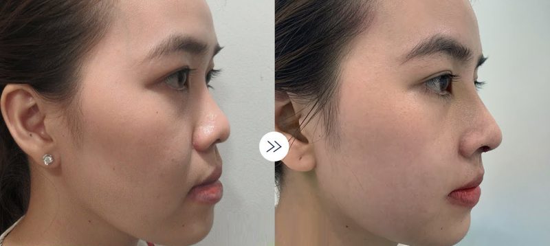 Nâng mũi Sline tạo nên diện mạo đẹp hoàn hảo cho khuôn mặt